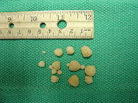 Calcium oxalate stones